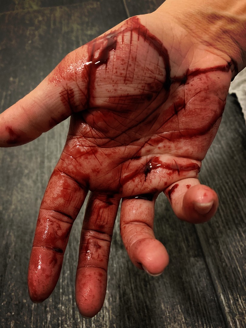 Hangnail